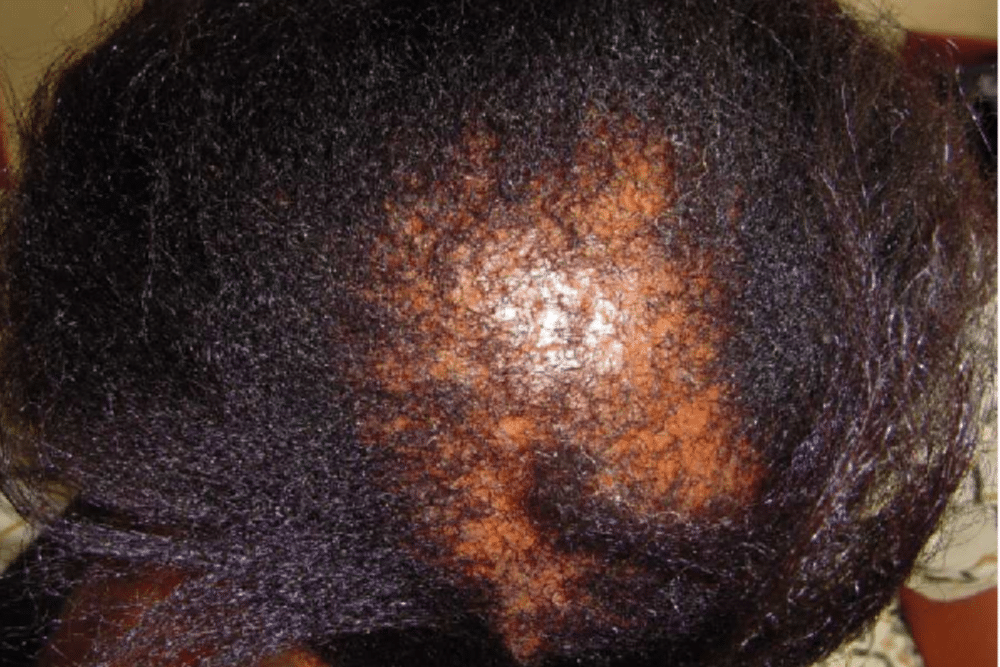 woman's scalp with burns and hair damage loss due to relaxer