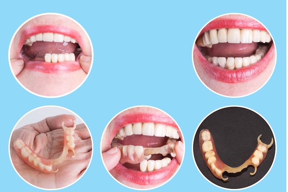 five photos showing dental restoration using partial dentures