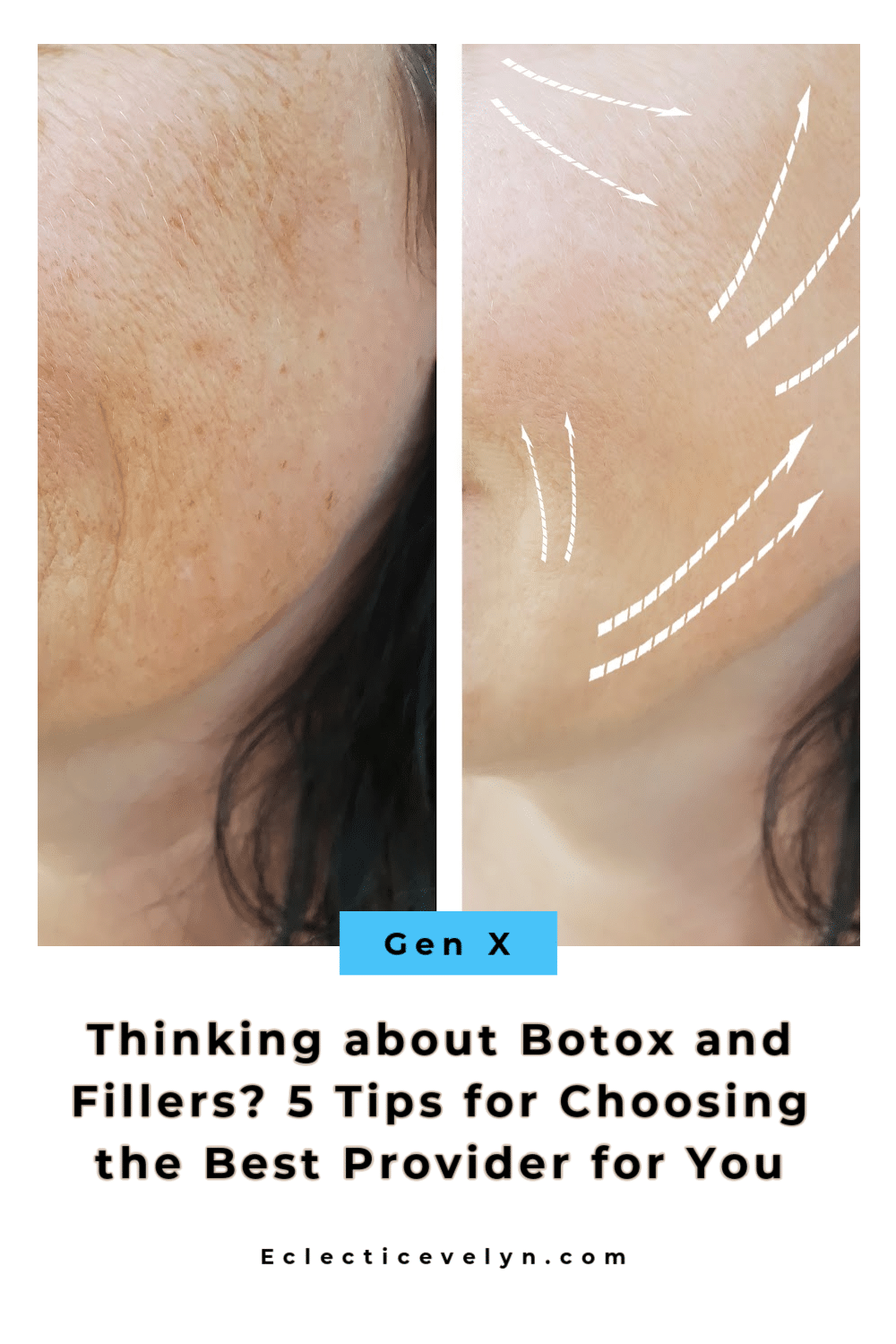 Thinking about Botox and Fillers? 5 Tips for Choosing the Best Provider for You with a before and after of a woman over 40 cheek